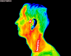 Carotid artery inflammation