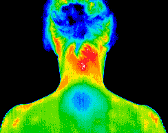 Underactive thymus gland