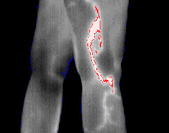 Underactive thymus gland