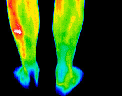 Dental infection/cardiovascular dysfunction