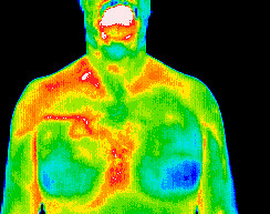 Dental infection/cardiovascular dysfunction